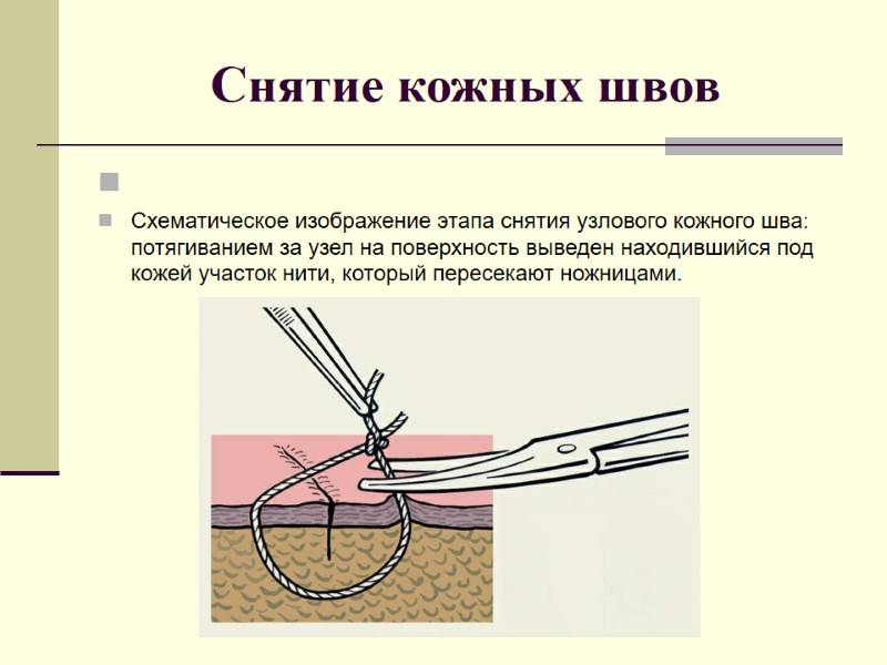 Снятие кожных швов   Схематическое изображение этапа снятия узлового кожного шва: потягиванием за